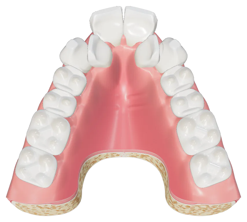 Illustration, viewed from below: a narrow, high-arched upper jaw with crowded teeth
