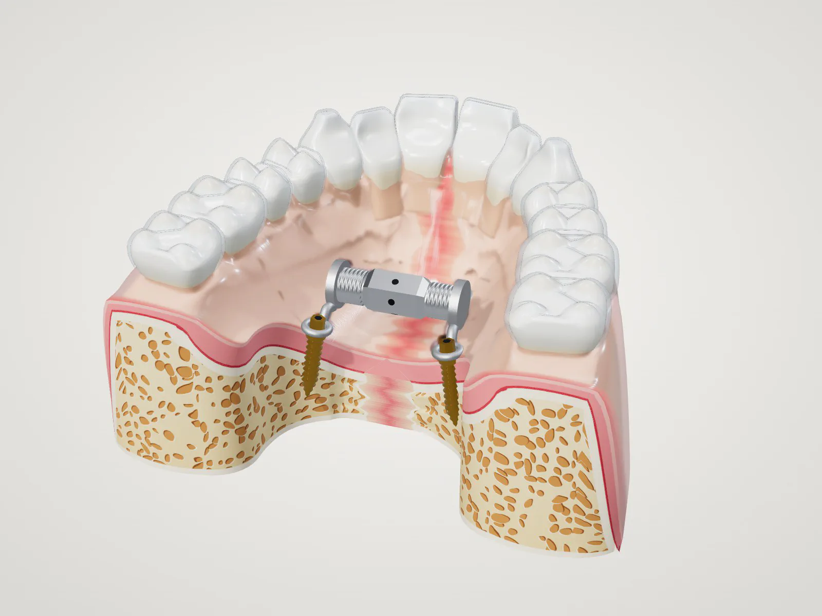 Illustration of an upper jaw in cross-section: a small expander held by mini-implants in the palate bone, with the seam down the middle of the palate opening and clear aligners over the teeth