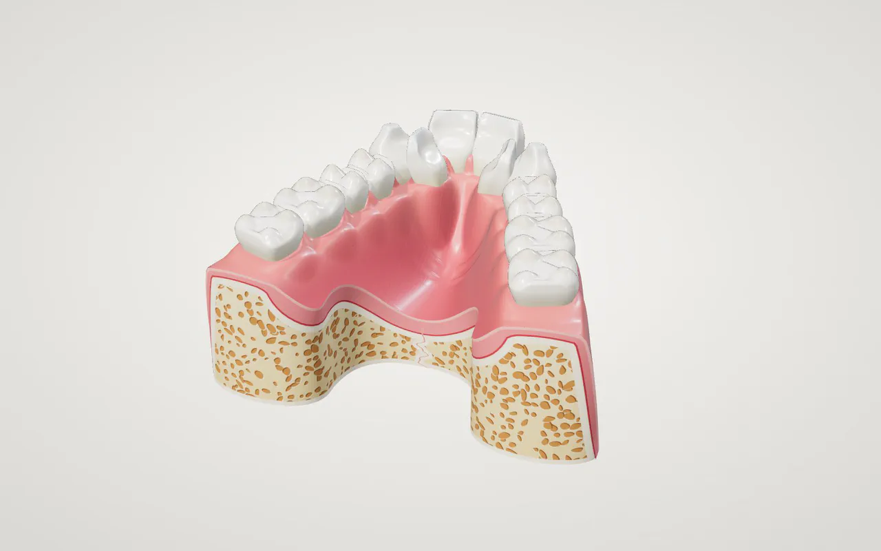 Illustration of a narrow upper jaw with crowded teeth, before treatment