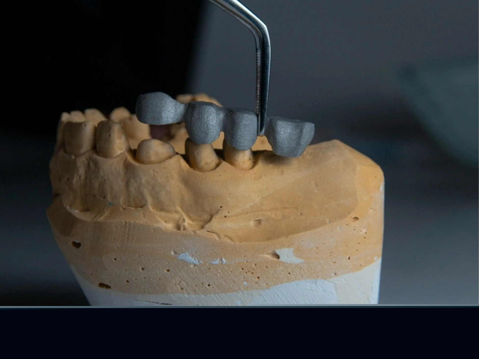 Dental Bridges Kurri Kurri | Replace Missing Teeth | Happy Tooth