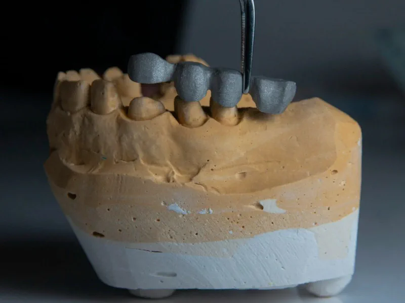 Dental Bridges at Happy Tooth Kurri Kurri