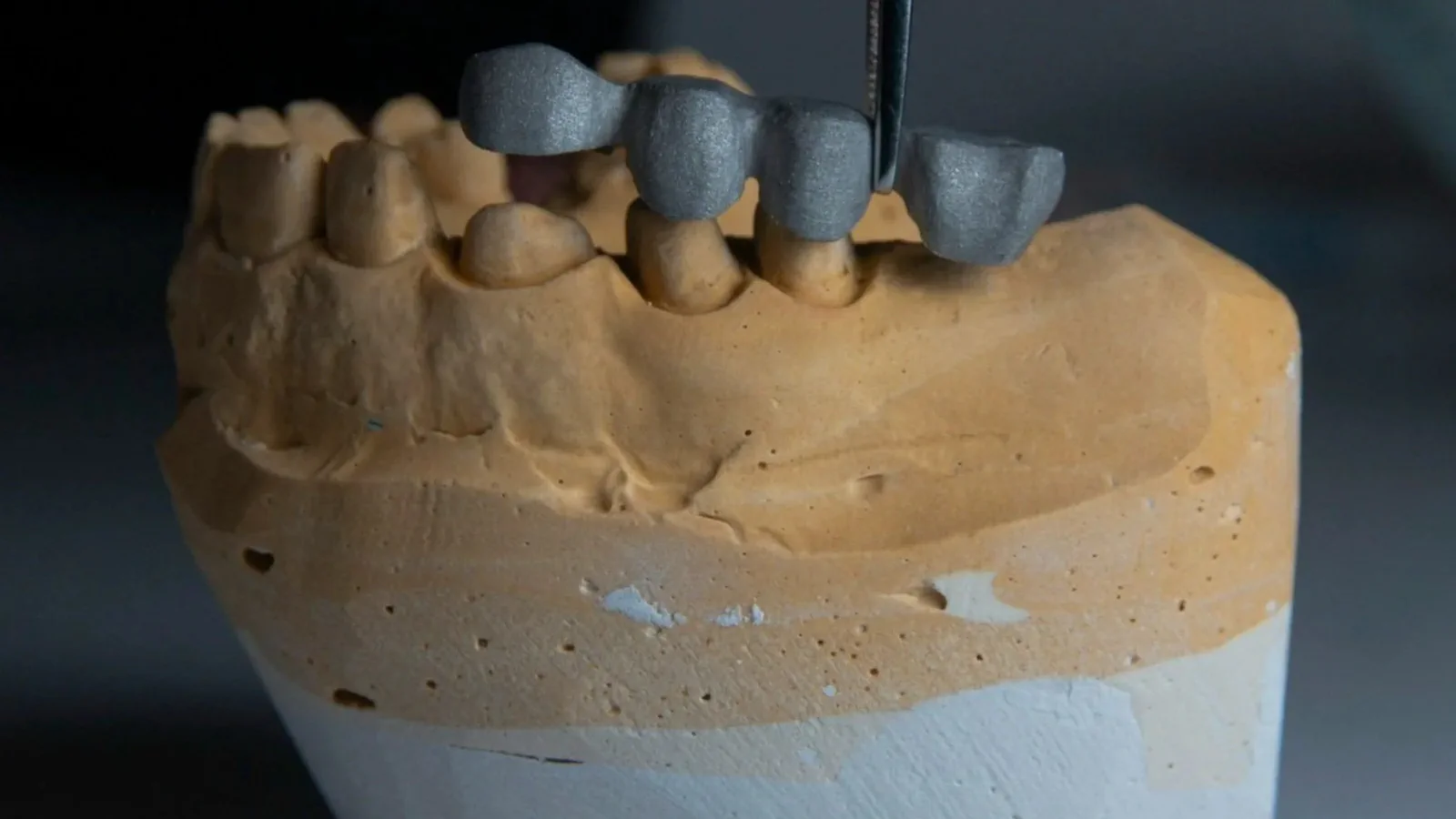 Dental Bridges at Happy Tooth Kurri Kurri