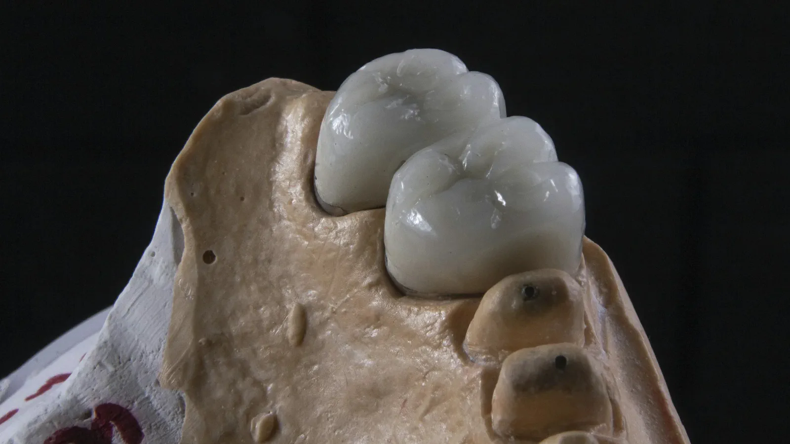 Same-Day CEREC Crowns at Happy Tooth Kurri Kurri