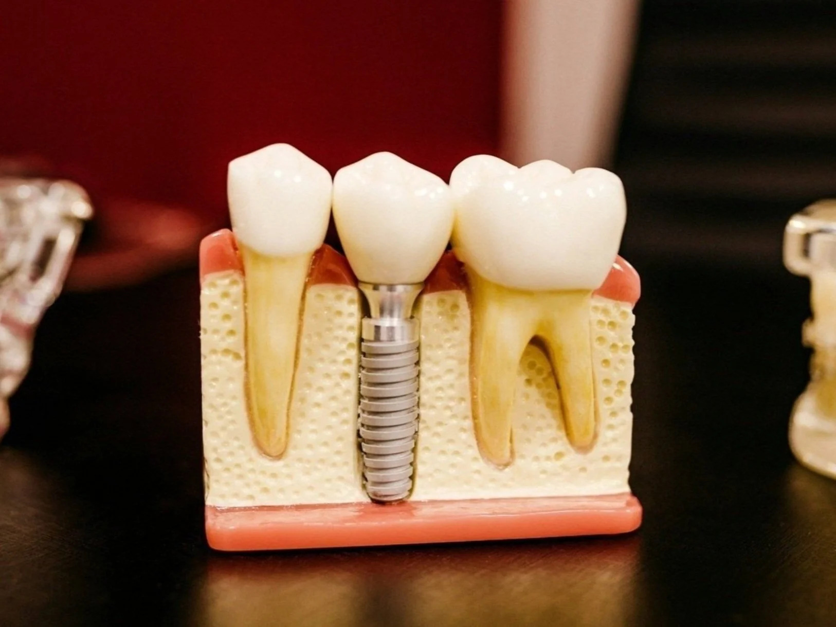 Dental Implants at Happy Tooth Kurri Kurri