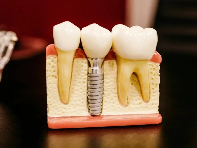 Dental Implants at Happy Tooth Kurri Kurri
