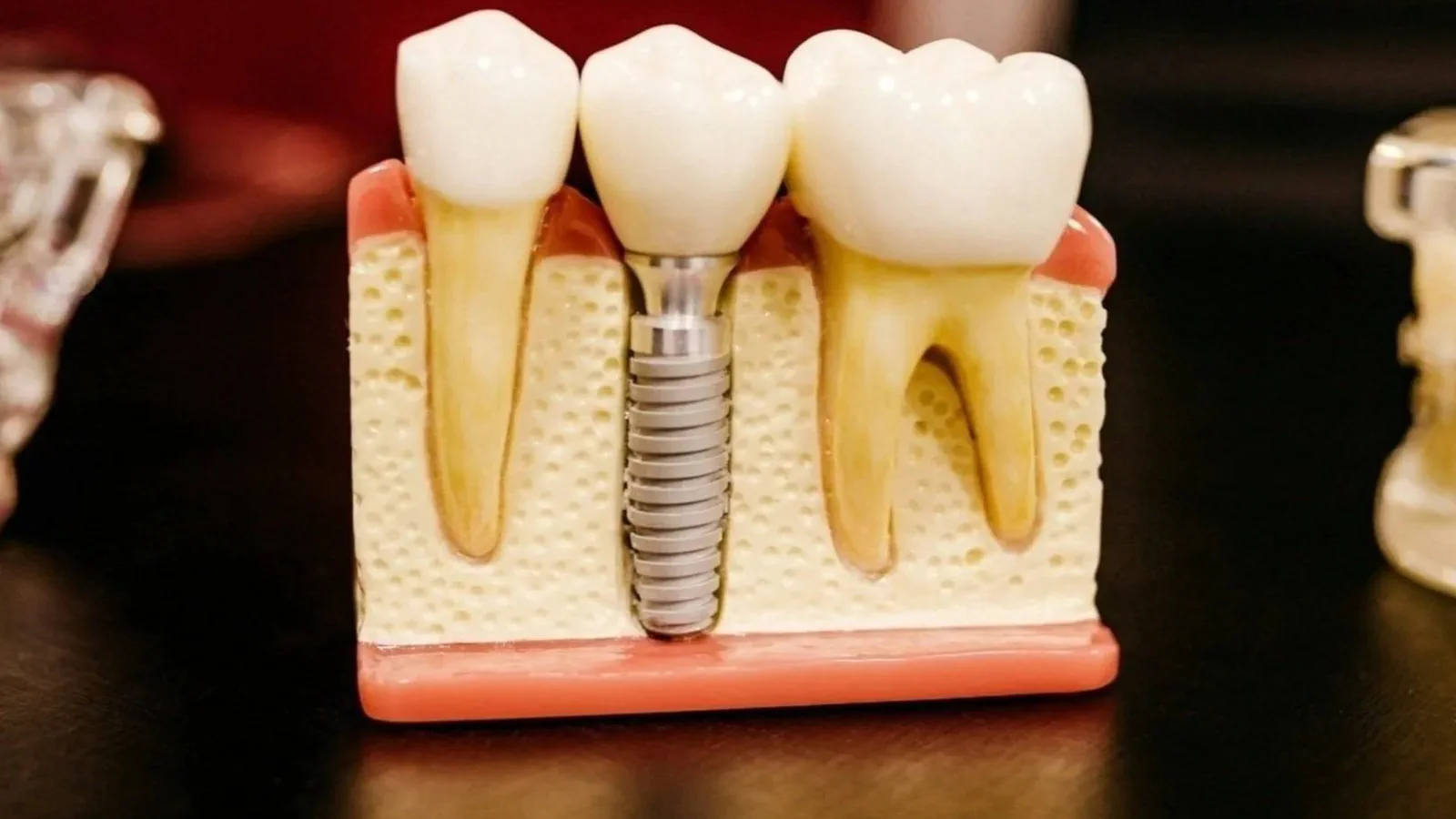 Dental Implants at Happy Tooth Kurri Kurri