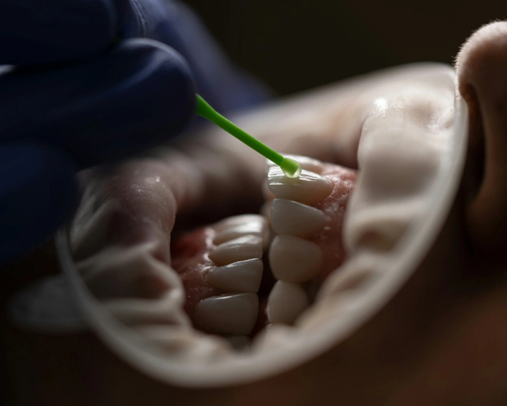 Fillings at Happy Tooth Kurri Kurri