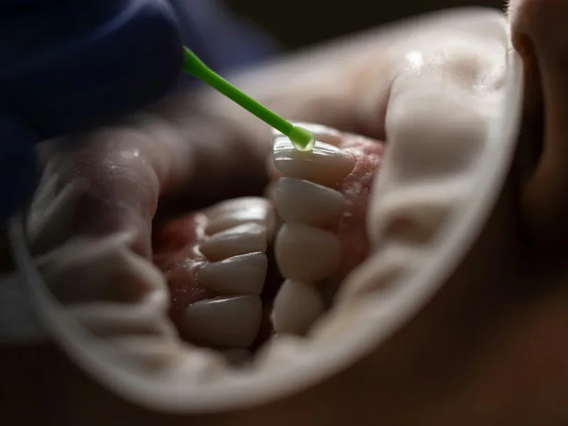 Fillings at Happy Tooth Kurri Kurri