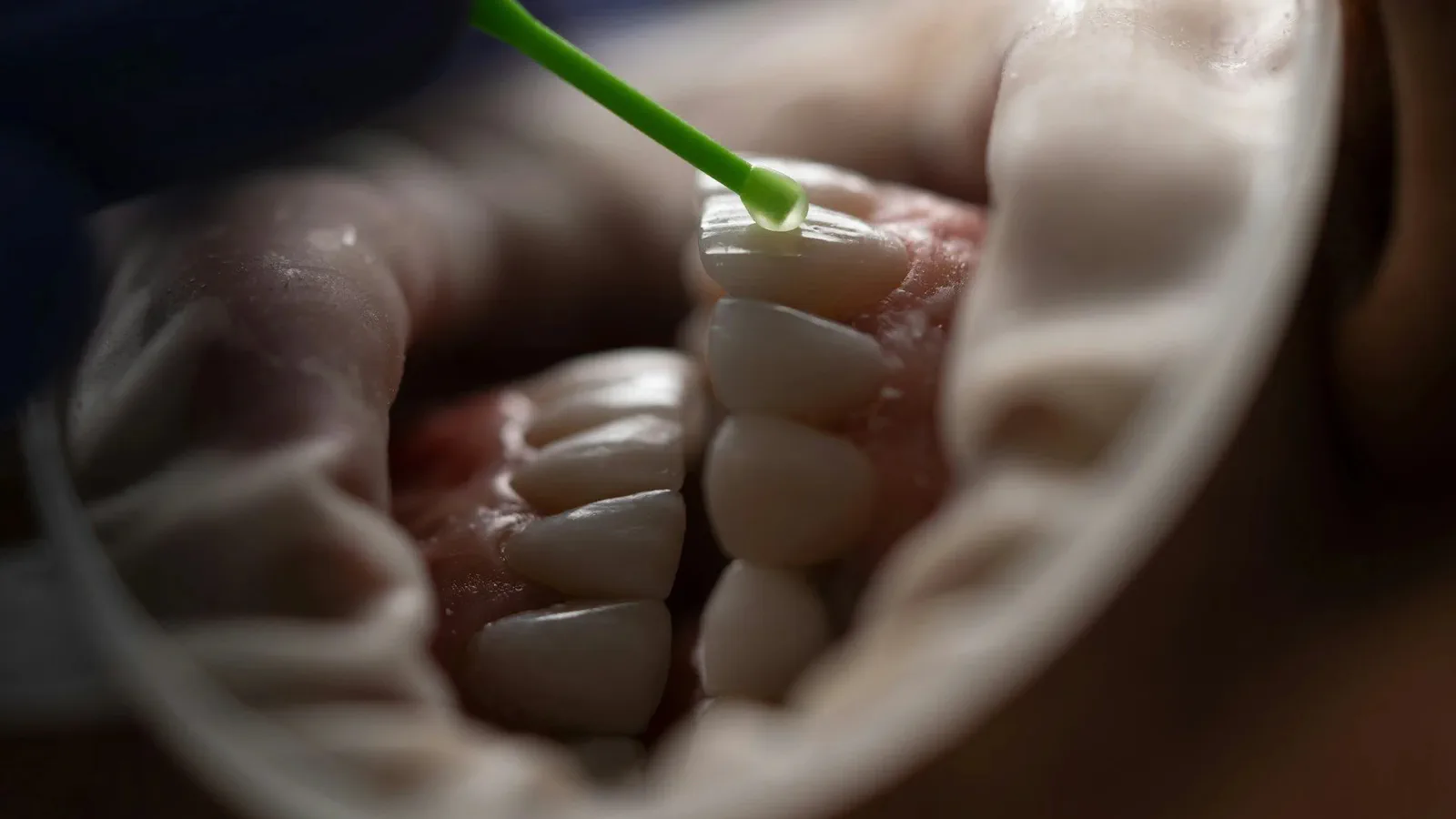 Dental Fillings at Happy Tooth Kurri Kurri