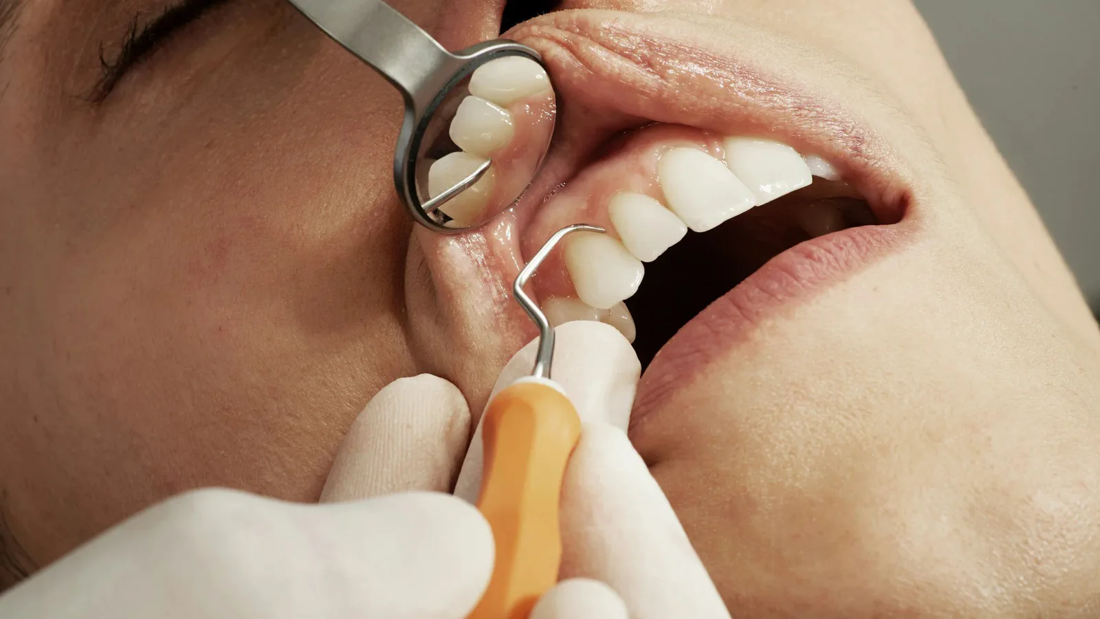 Gum Disease Treatment at Happy Tooth Kurri Kurri