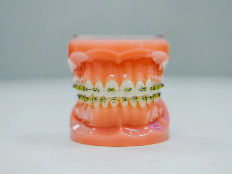 Orthodontics & Aligners at Happy Tooth Kurri Kurri