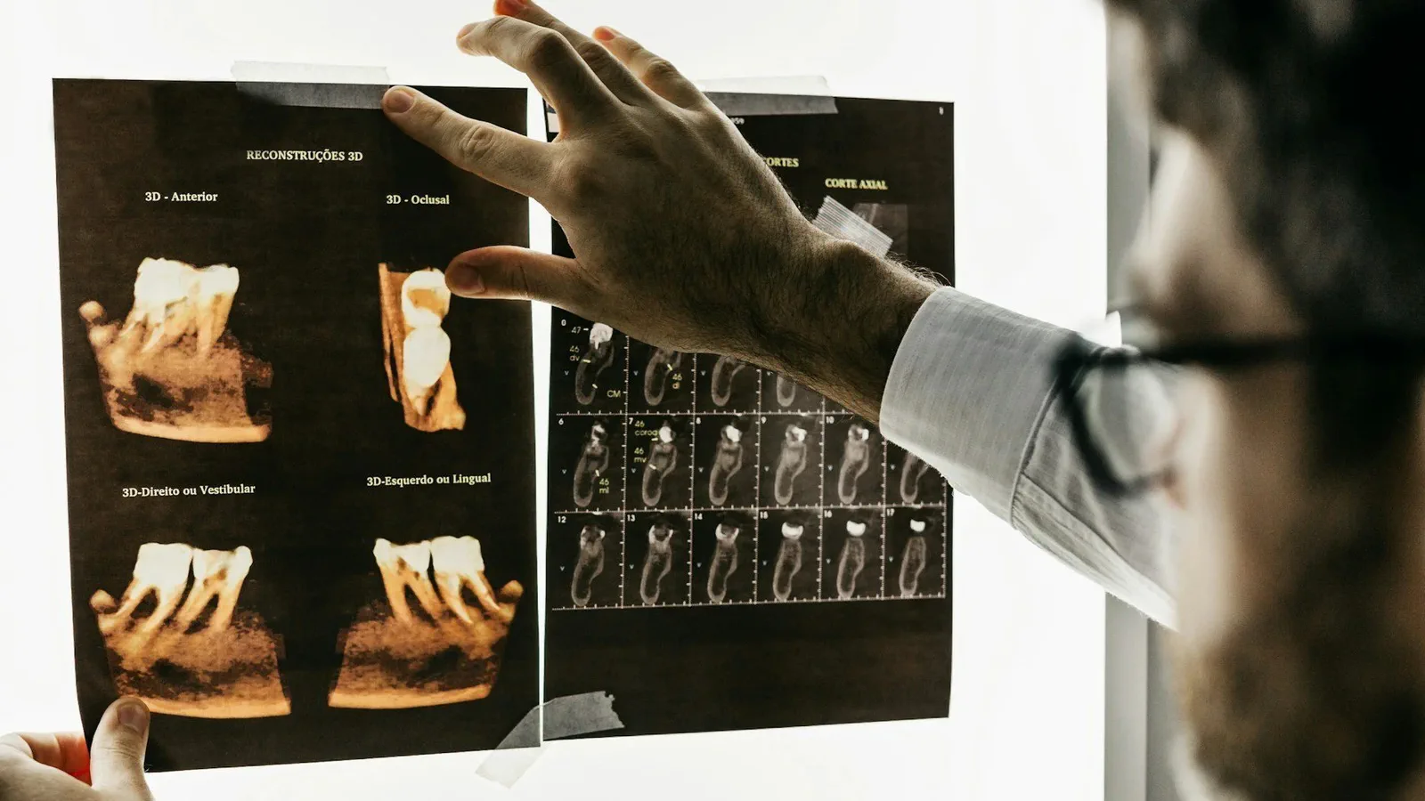 Root Canal Therapy at Happy Tooth Kurri Kurri