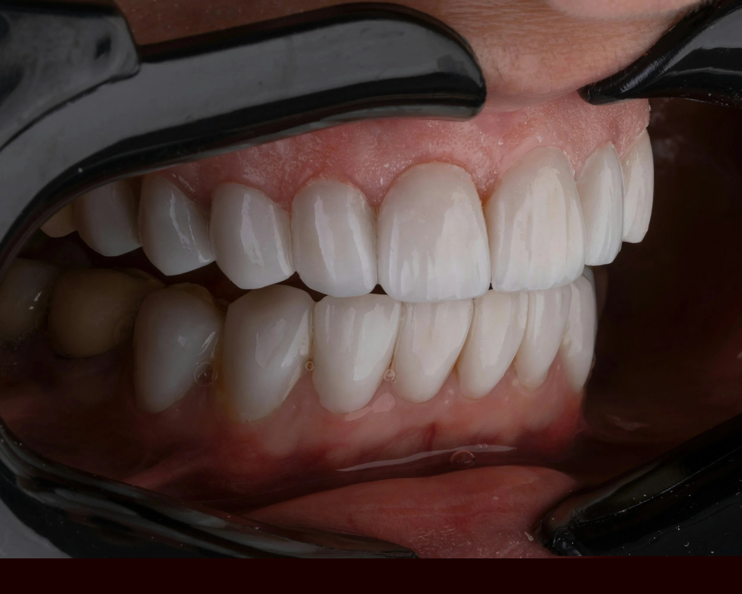 Veneers at Happy Tooth Kurri Kurri