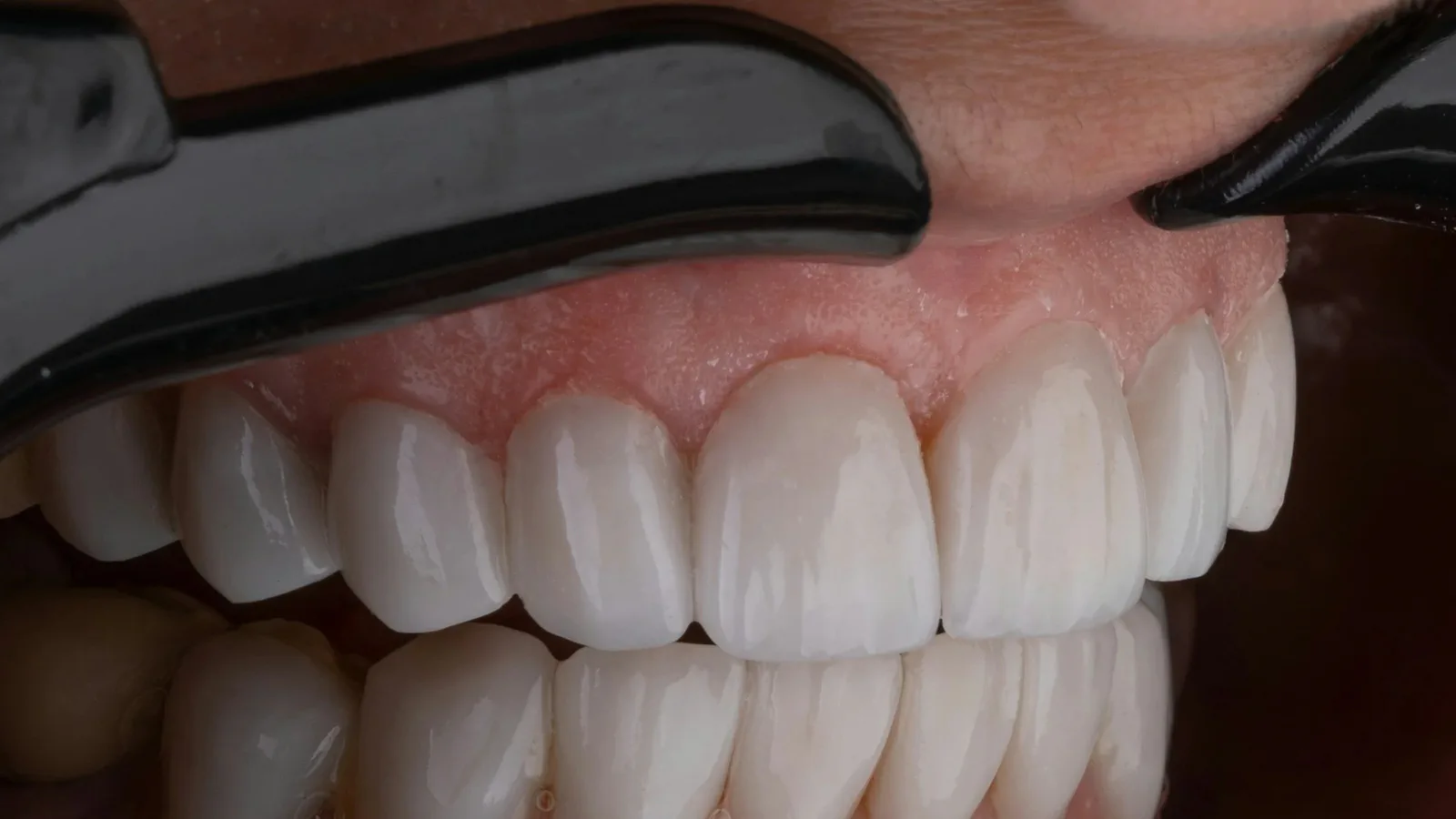 Porcelain Veneers at Happy Tooth Kurri Kurri