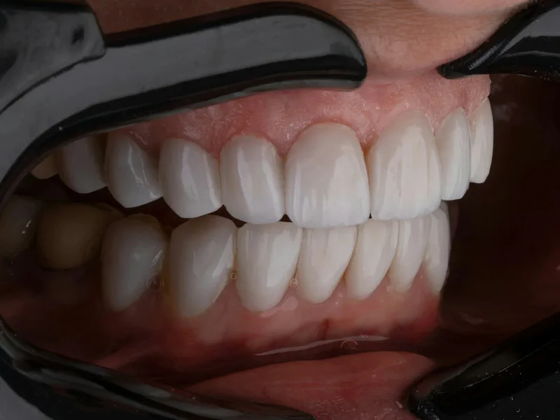 Veneers at Happy Tooth Kurri Kurri