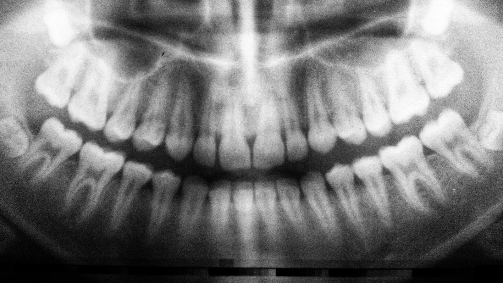 Wisdom Teeth Removal at Happy Tooth Kurri Kurri