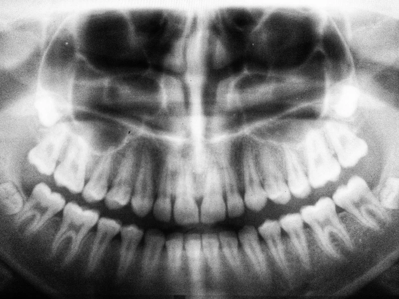 Wisdom Teeth Removal at Happy Tooth Kurri Kurri
